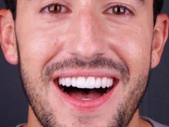 Lente de Contato Dental na Barra da Tijuca - Irioodonto