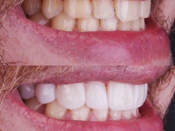 Lente de Contato Dental na Barra da Tijuca - Irioodonto