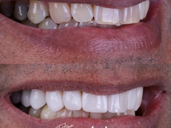 Lente de Contato Dental na Barra da Tijuca - Irioodonto