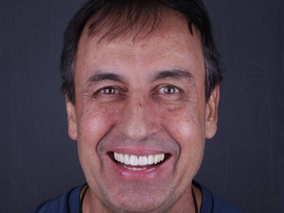 Lente de Contato Dental na Barra da Tijuca - Irioodonto
