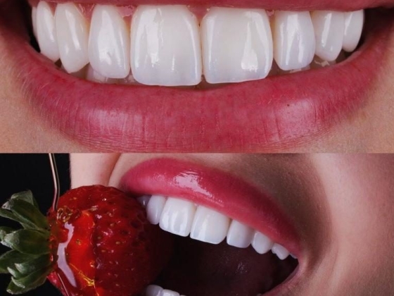Lente de Contato Dental na Barra da Tijuca - Irioodonto