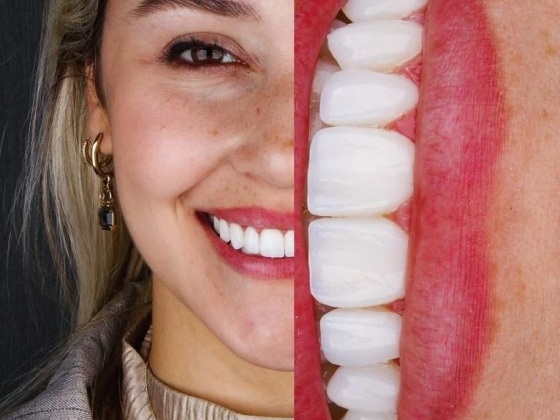 Lente de Contato Dental na Barra da Tijuca - Irioodonto